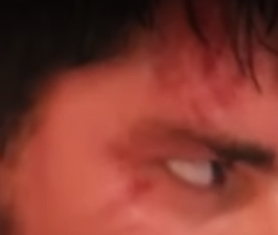 Temple Injury cropped.png